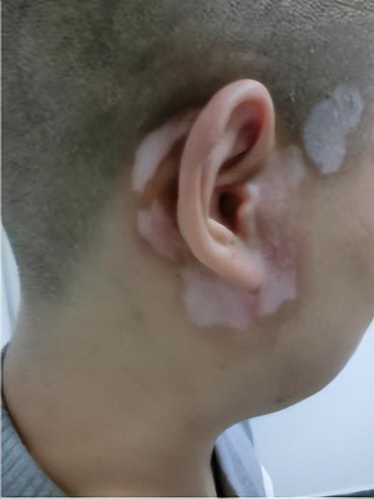 白癜風(fēng)最新治療方法研究與應(yīng)用進(jìn)展